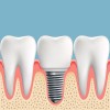 implant2