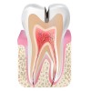 root_canal